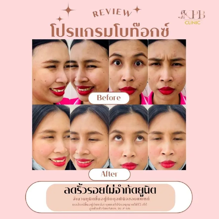 รีวิวโปรแกรมโบท็อกซ์ KPB Clinic