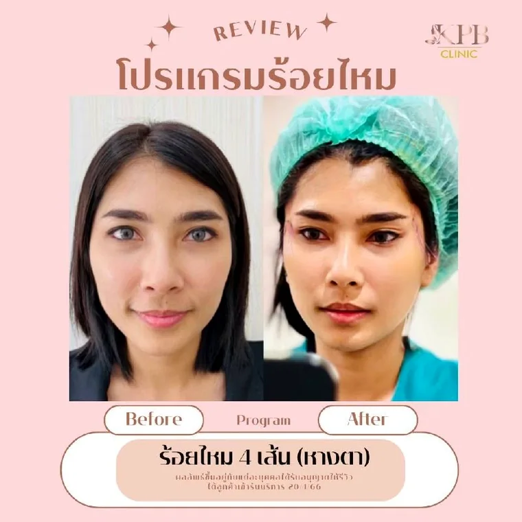 รีวิวโปรแกรมร้อยไหม KPB Clinic