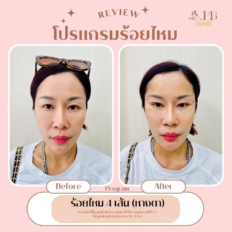 รีวิวโปรแกรมร้อยไหมบริเวณหางตา KPB Clinic